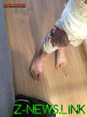 В Одессе нашли семилетнего ребенка со страшными ожогами